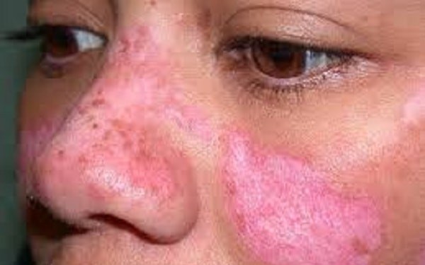 Mắc lupus ban đỏ hệ thống cần lưu ý những điều này