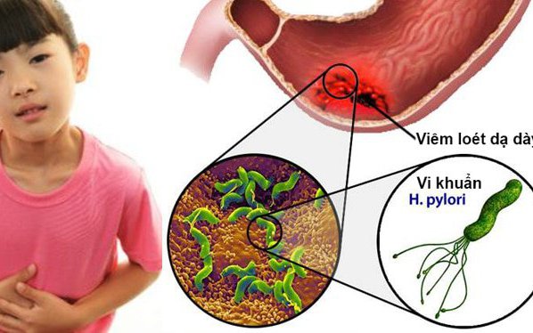 Kháng kháng sinh và chiến lược điều trị vi khuẩn H.Pylori ở trẻ em