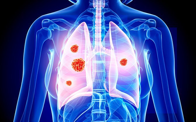 Điều trị ung thư phổi không tế bào nhỏ bằng liệu pháp miễn dịch