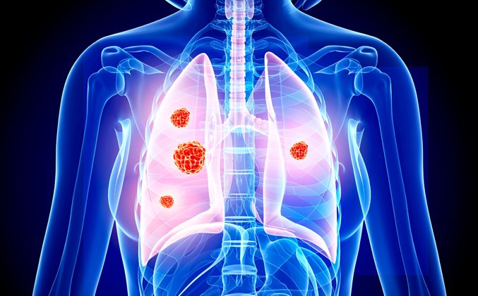 Cứ 5 người mắc ung thư phổi trên thế giới, có 3 ca thuộc khu vực Châu Á: Đâu là lý do? - Ảnh 1.