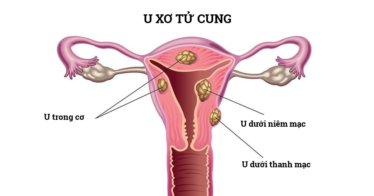 Khỏe 247 tư vấn U xơ tử cung