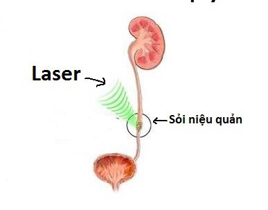 Tán sỏi ngoài cơ thể là phương pháp điều trị ngoại khoa sỏi tiết niệu được áp dụng phổ biến và không mất thời gian nằm viện, chủ yếu dành cho những sỏi nhỏ. Ảnh minh họa