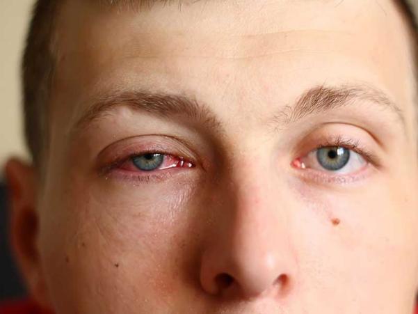 Hiệu quả và thời gian điều trị viêm kết mạc mắt là bao lâu?
