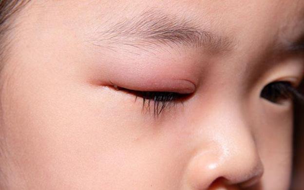 Viêm bờ mi tưởng nhẹ mà không nhẹ