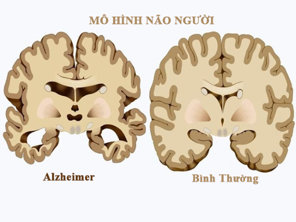 Bài thuốc hiệu nghiệm hỗ trợ trị chứng lẩn thẩn ở người cao tuổi - Ảnh 2.