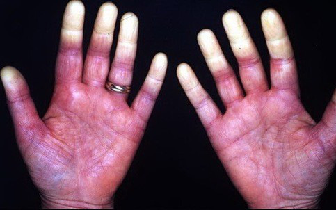 Hội chứng Raynaud là gì, chữa thế nào?