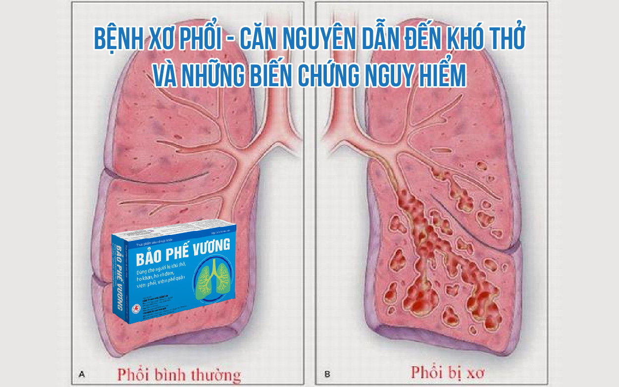 Bệnh xơ phổi – Căn nguyên dẫn đến khó thở và những biến chứng nguy hiểm