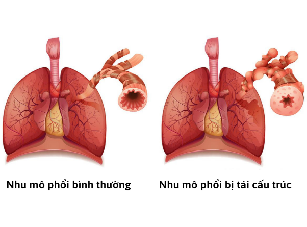 Cải thiện triệu chứng xơ phổi hậu đại dịch nhờ hoạt chất Fibrolysin
