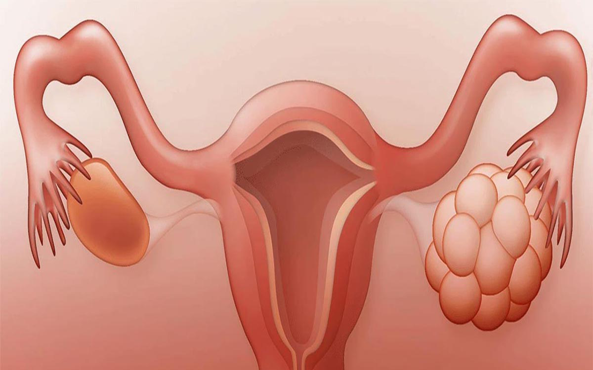 Các biện pháp kiểm soát sinh sản tốt nhất cho phụ nữ bị buồng trứng đa nang