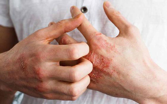 6 cách kiểm soát ngứa da khi bạn bị bệnh vẩy nến
