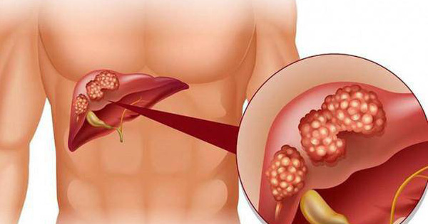 5 dấu hiệu cảnh báo gan của bạn đang nhiễm độc