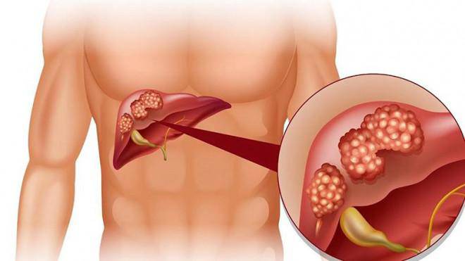5 dấu hiệu cảnh báo gan của bạn đang nhiễm độc
