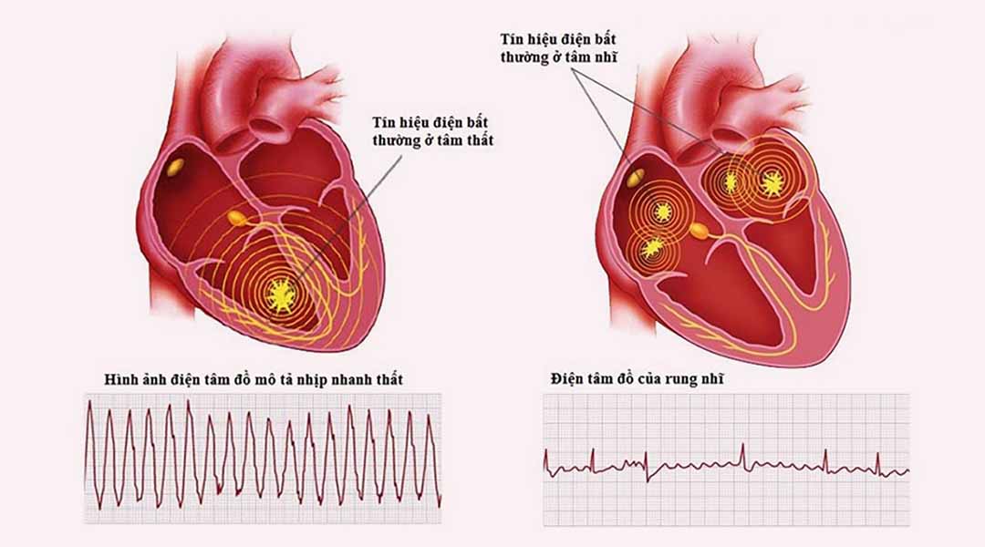 Các Rối Loạn Nhịp Tim Thường Gặp