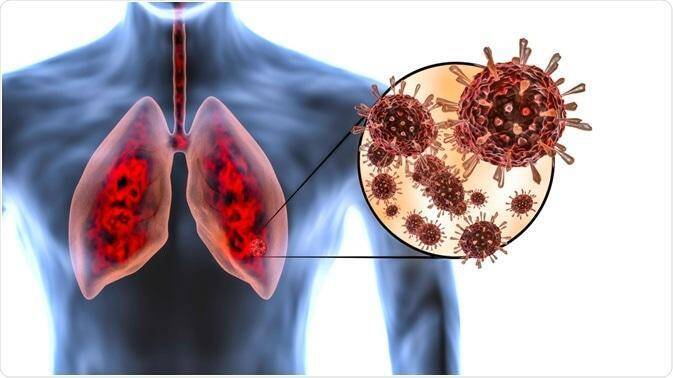 Khó thở dai dẳng là dấu hiệu tổn thương phổi ở bệnh nhân mắc COVID-19