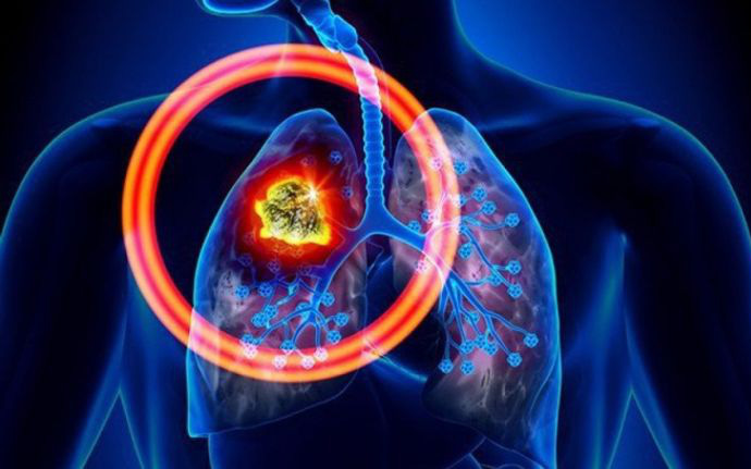 Ung thư phổi: Nguyên nhân, yếu tố nguy cơ gây bệnh và điều trị