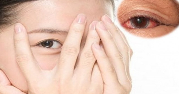 Cảnh giác với chứng đau mắt, đỏ mắt hậu COVID-19
