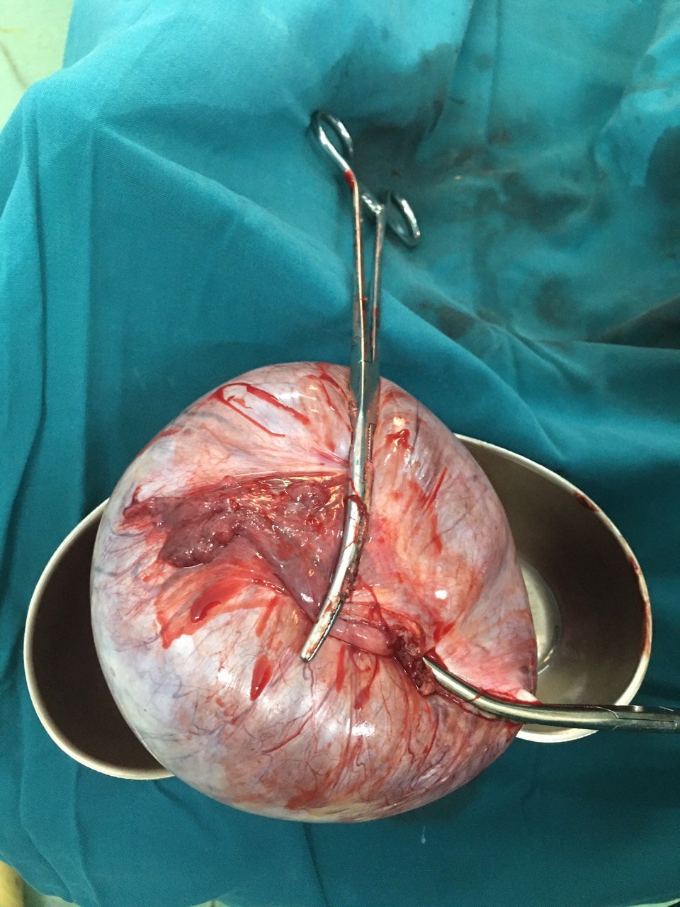 Mổ lấy thai và cắt u buồng trứng khủng cho thai phụ tại Quảng Bình - Ảnh 2.