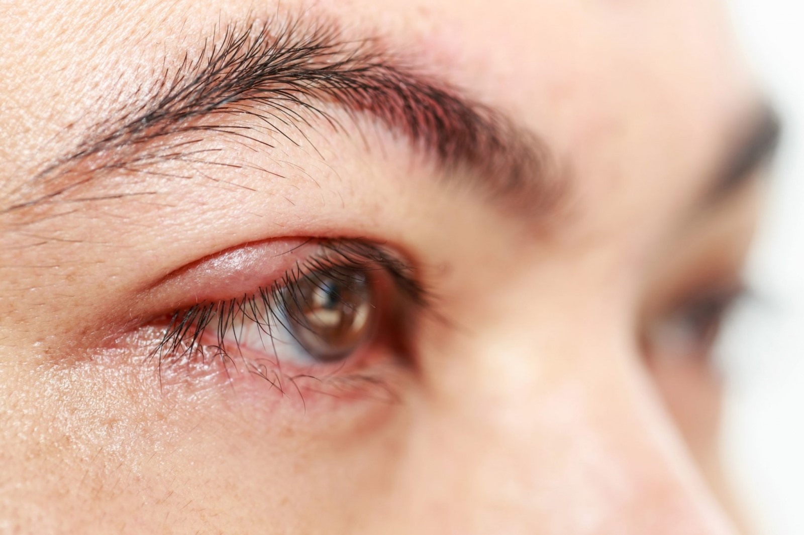 Phòng ngừa lẹo mắt tái phát