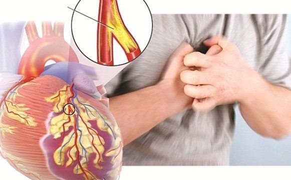 Nhận biết cơn đau tức ngực của bệnh mạch vành - Ảnh 1.