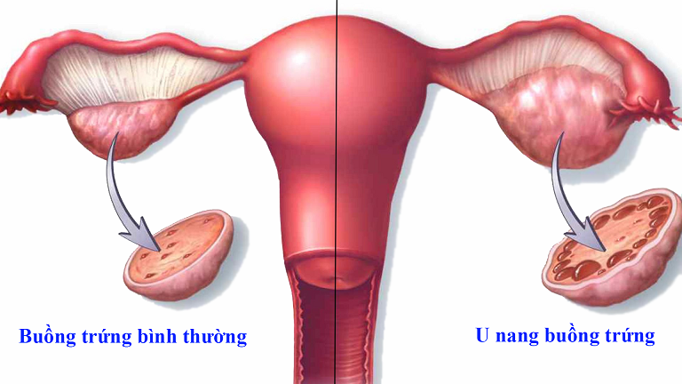 Chị em gặp 1 trong 4 tình trạng này, rất có thể là dấu hiệu của u nang buồng trứng