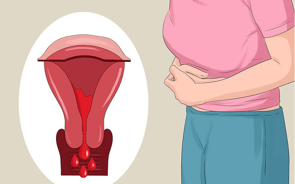 Ung thư nội mạc tử cung: Nguyên nhân, dấu hiệu và giai đoạn phát triển