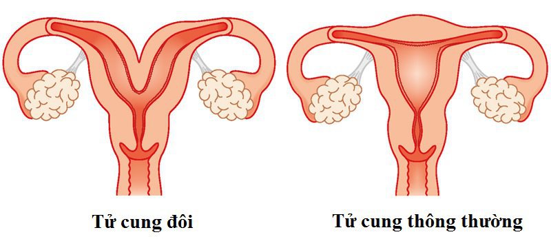 Những điều cần biết về dị dạng tử cung - Ảnh 2.