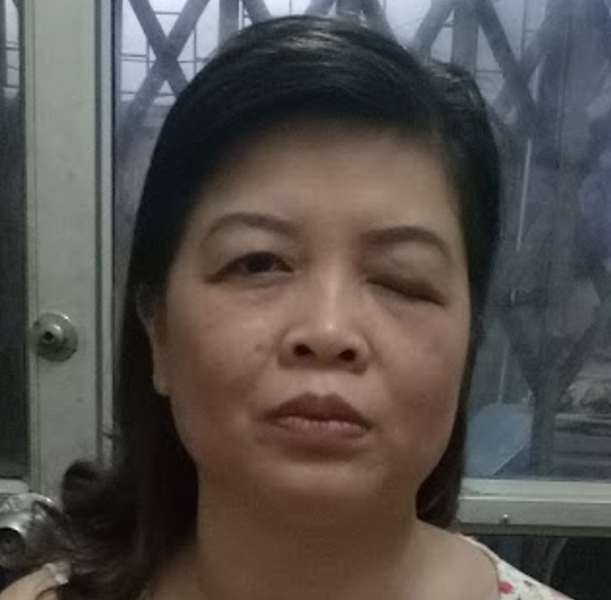 Bênh sụp mí mắt: Nguyên nhân, triệu chứng và cách điều trị bằng Đông y - Ảnh 2. Bênh sụp mí mắt: Nguyên nhân, triệu chứng và cách điều trị bằng Đông y - Ảnh 2.