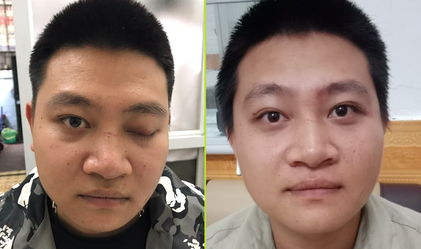 Bênh sụp mí mắt: Nguyên nhân, triệu chứng và cách điều trị bằng Đông y - Ảnh 3. Bênh sụp mí mắt: Nguyên nhân, triệu chứng và cách điều trị bằng Đông y - Ảnh 3.