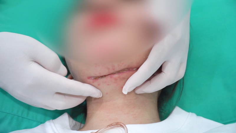 Cô gái nhập viện với vết cắt dài trên cổ sau tiêm tan mỡ nọng cằm
