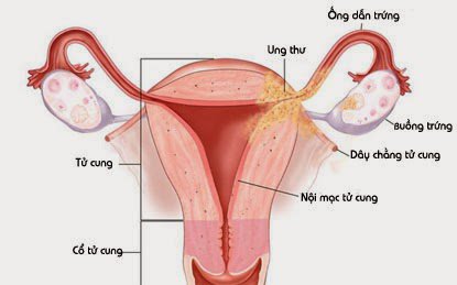 Tăng sản nội mạc tử cung là gì và điều trị như thế nào? - Ảnh 2.