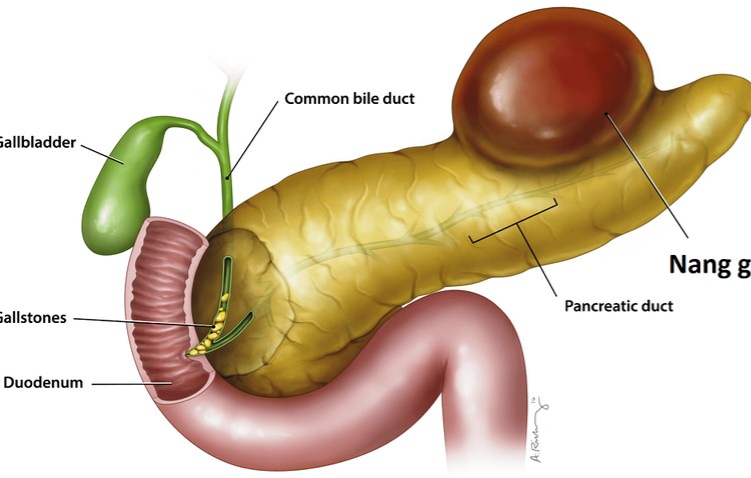 Nang giả tụy cần cảnh giác với các biểu hiện đau bụng, buồn nôn ...