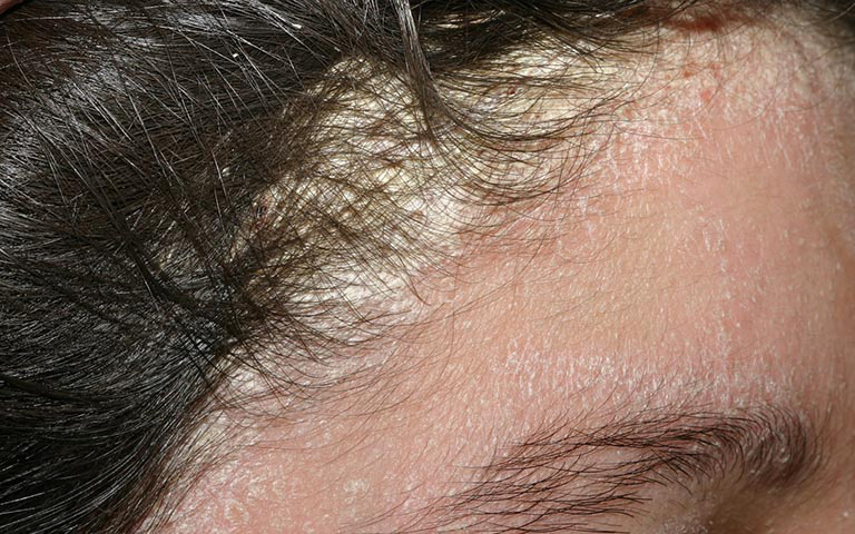 5 biện pháp tự nhiên chữa vẩy nến da đầu