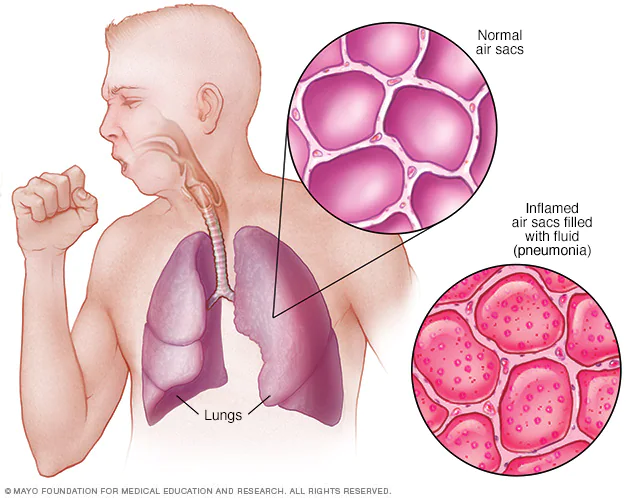 Viêm phổi - Kháng sinh - Tiêu chảy: Ám ảnh kéo dài mỗi khi giao mùa của mẹ bỉm - Ảnh 1.
