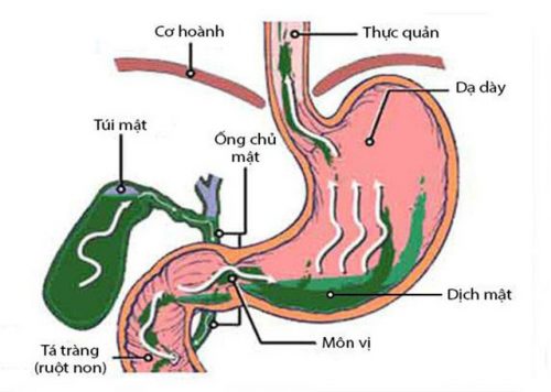 Trào ngược dịch mật: nhận biết, nguyên nhân và những lưu ý - Ảnh 4.