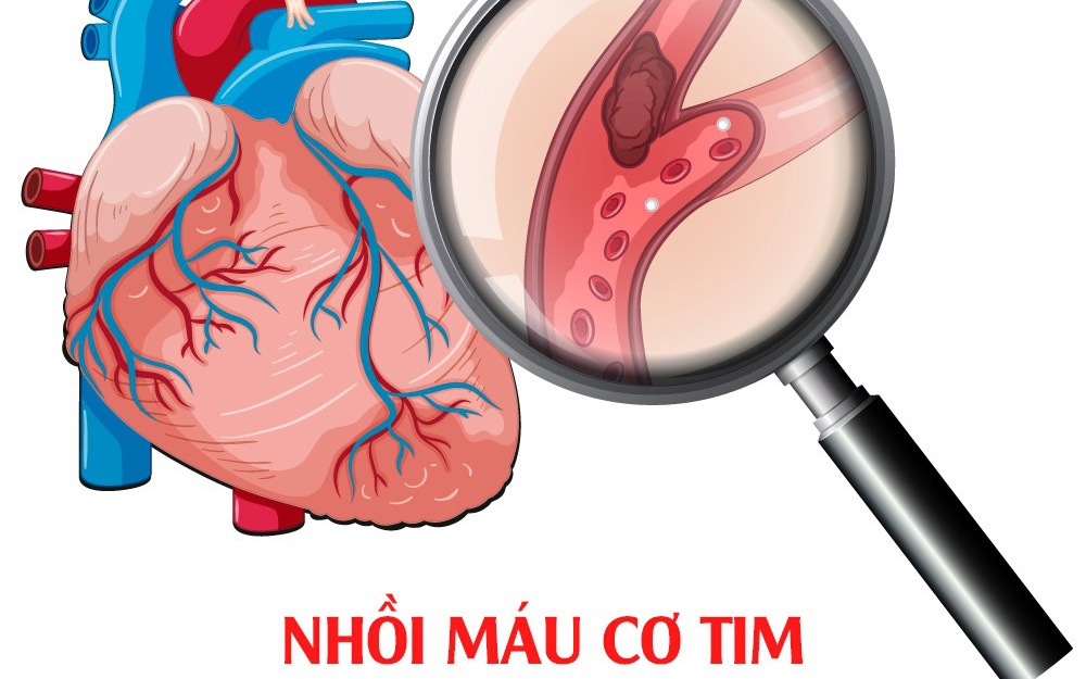 Nhồi máu cơ tim - các dấu hiệu cảnh báo sớm và cách xử trí để hạn chế tử vong