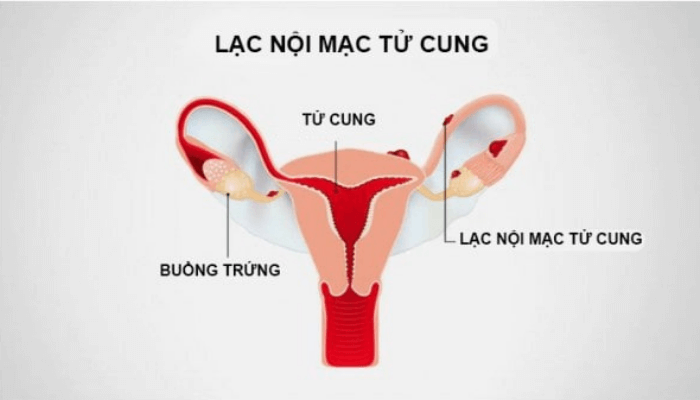 Tử Cung Co Thắt: Nguyên Nhân, Triệu Chứng Và Cách Điều Trị Hiệu Quả