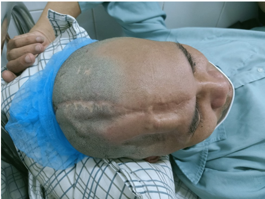 Ghép sọ tạo hình 3Dcho nhân viên y tế bị tai nạn giao thông - Ảnh 1.