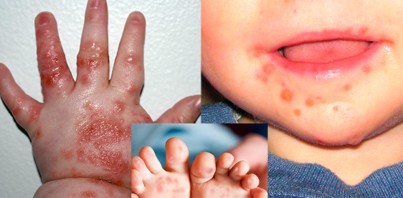 6 lý do khiến bệnh tay chân miệng nguy hiểm với trẻ em