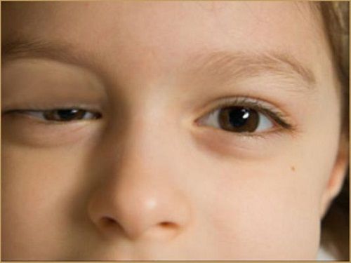 Sụp mi mắt: Nguyên nhân, triệu chứng, điều trị và cách khắc phục - Ảnh 1.