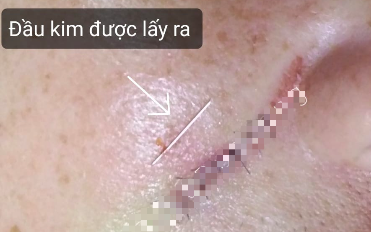 Gãy kim khi đang tiêm filler xoá rãnh mũi má ở tiệm tóc