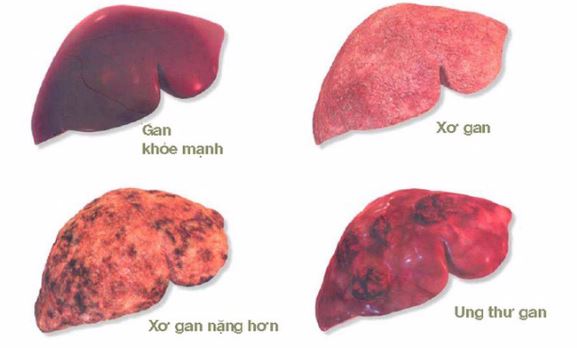 Biến chứng xơ gan: Những điều nên làm để phòng tránh hệ lụy - Ảnh 1.