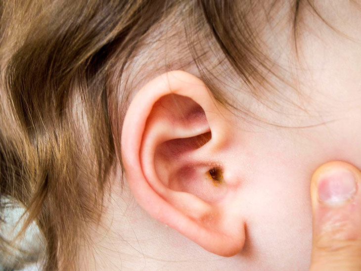 Dùng thuốc trị viêm tai giữa cấp ở trẻ như thế nào là đúng? - Ảnh 1.