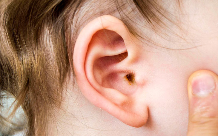 Cách dùng thuốc trị viêm tai giữa cấp ở trẻ