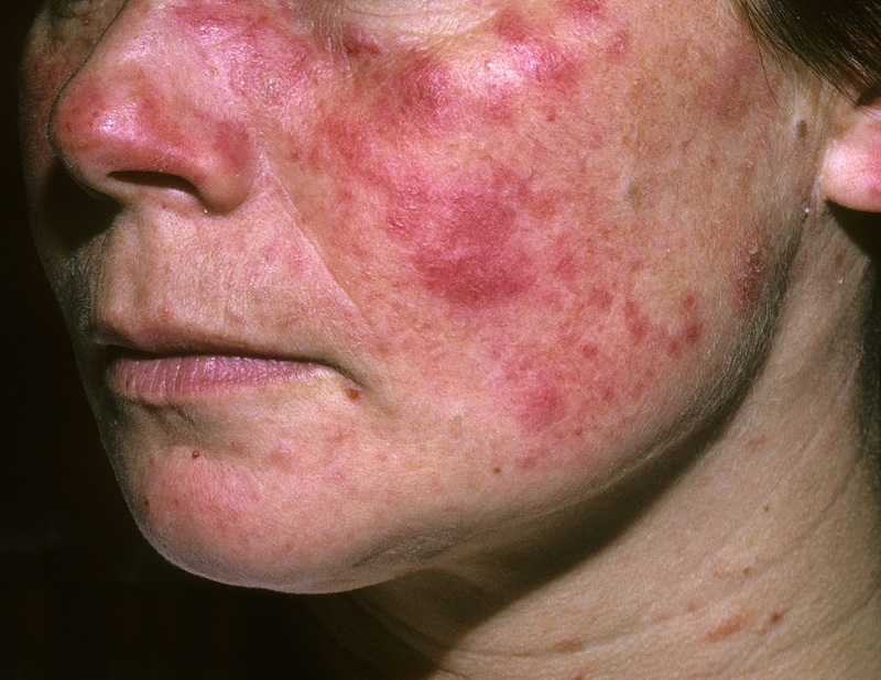 Bị viêm, đỏ, đau do lupus ban đỏ hành xuyên ngày đêm, giải pháp ở đây