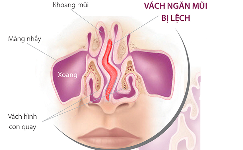 Nguyên Nhân Gây Vẹo Vách Ngăn Mũi