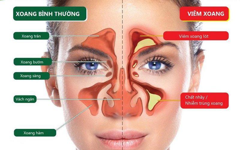 Đề phòng viêm mũi, xoang dị ứng khi thời tiết thất thường