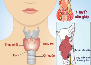 Cảnh giác với loại u thường gặp ở phụ nữ, diễn tiến âm thầm thời gian dài, khi phát hiện thường đã muộn   - Ảnh 1.