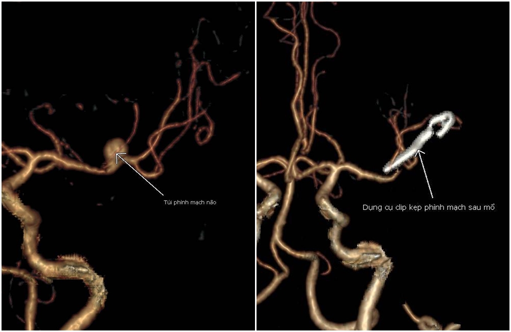 Đột ngột choáng váng, nói khó người đàn ông phát hiện xuất huyết não nguy kịch tính mạng - Ảnh 2.