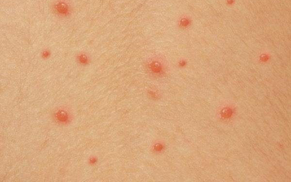 Thủy đậu dễ lây nhất khi nào và cách chăm sóc để không bị bội nhiễm?