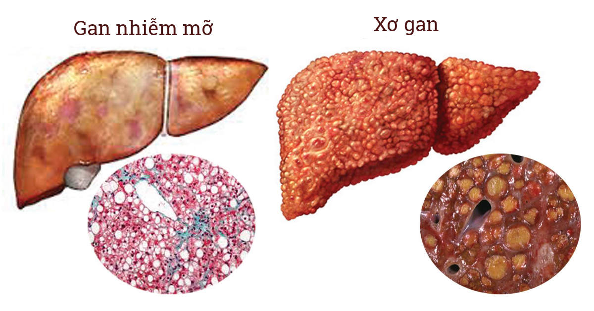 Coi chừng gan nhiễm mỡ có thể gây xơ gan, ung thư gan